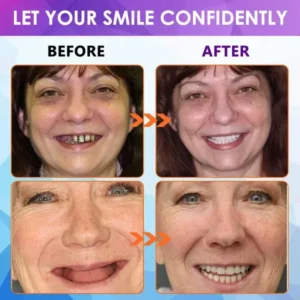 YUNPSO™ Advanced Customized Full Denture Set