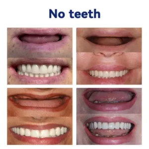 YUNPSO™ Advanced Customized Full Denture Set