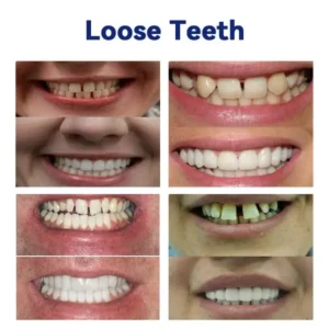 YUNPSO™ Advanced Customized Full Denture Set