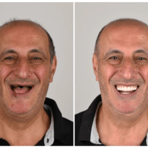 YUNPSO™ 3D Dentures
