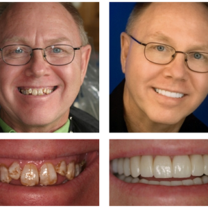 YUNPSO™ 3D Dentures
