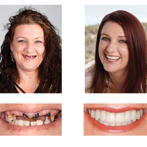 YUNPSO™ 3D Dentures