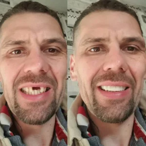 Alternative view of YUNPSO™ -Advanced Custom-Fit Functional Dentures