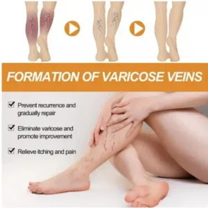 YUNPSO Turmeric Varicose Veins Relief Spray