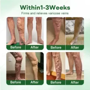 Croaie® VeinLock Microneedle Patch