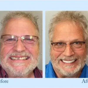 NESLEMY™ Custom-Fit Functional Dentures – Perfectly Fitted in Minutes at Home