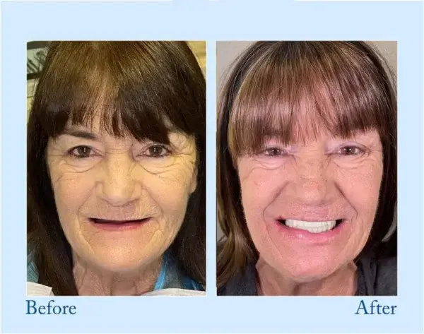 NESLEMY™ Custom-Fit Functional Dentures – Perfectly Fitted in Minutes at Home