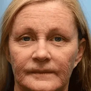 Rolimey® Botox Bee Venom Skin Treatment Cream