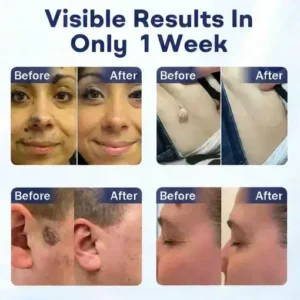 YUNPSO® Mole and Wart Removal Cream