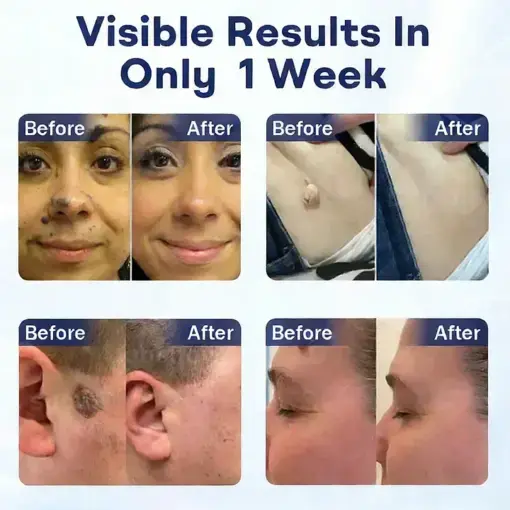 YUNPSO® Mole and Wart Removal Cream