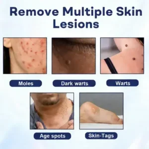 YUNPSO® Mole and Wart Removal Cream