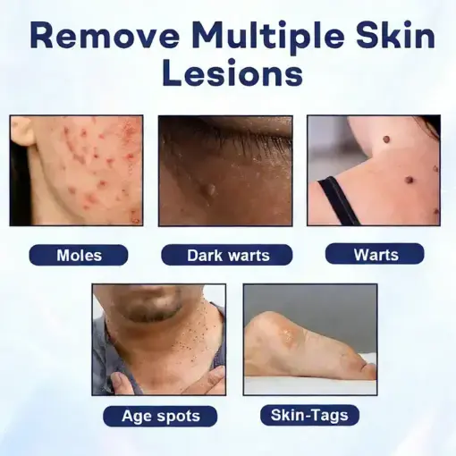 YUNPSO® Mole and Wart Removal Cream